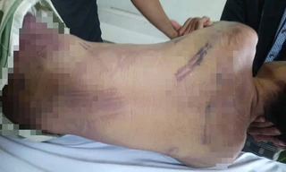 Thi thể của phạm nhân L. được phát hiện với nhiều vết bầm tím