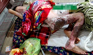 Cậu bé T. bị bỏng nặng sau khi bị mẹ đẩy vào đống lửa