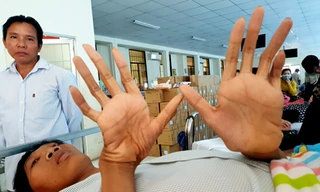 16 năm tăng chiều cao bất thường của bệnh nhân 2,5 m