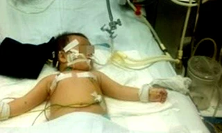 Bệnh nhi U. hiện vẫn đang trong tình trạng nguy kịch phải thở máy