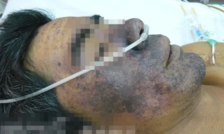 Người đàn ông này bị nhiễm liên cầu khuẩn do ăn tiết canh. Ảnh: BS Cấp cung cấp