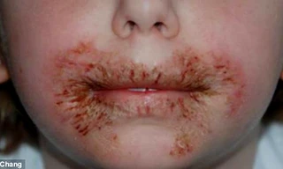 Một bé gái bị mẩn rát vùng miệng vì dị ứng chất bảo quản MI trong giấy ướt