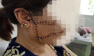 Chồng dùng dao lam rạch nát mặt vợ