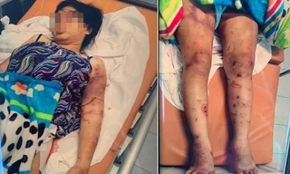 Chị Y bị hành hạ dã man và ép sử dụng ma túy đến sẩy thai