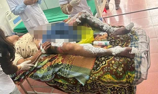 Điện thoại để trong túi quần phát nổ, nam thanh niên bỏng nặng vùng kín