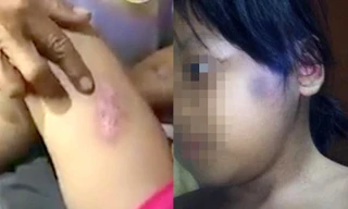 Bé gái 6 tuổi bị châm thuốc lá vào người