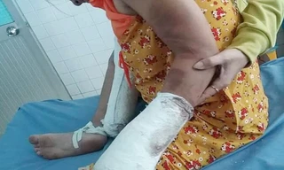Thai phụ bị người tình đánh gãy tay chân