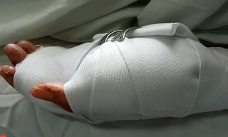 Bàn tay trái của chị H. được khớp nối thành công