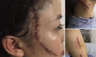 Lộ nguyên nhân cô gái 18 tuổi bị bạn dùng dao rạch mặt phải khâu hàng chục mũi