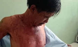 Nạn nhân Nguyễn Văn Lộc tại bệnh viện