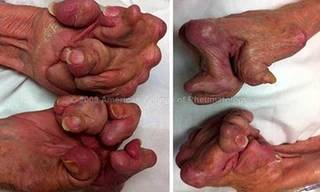 Đôi bàn tay bị biến dạng do không điều trị bệnh viêm khớp dạng thấp huyết thanh dương tính
