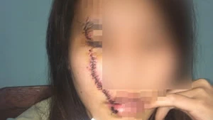 Cô gái bị rạch mặt khi ngồi sau xe máy của 'trai đã có vợ'