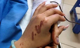 Nạn nhân bị tạt axit ở Quảng Ngãi: 'Tôi cứ tưởng là cướp'