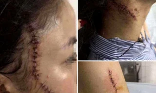 Nữ công nhân bị bạn trai rạch mặt sau trận cãi vã