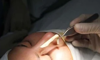 Cô gái bị mù một mắt sau khi tiêm chất nâng mũi