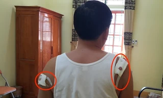 Vết thương trên người của ông Thanh do ông Thấu gây nên