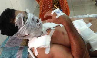 Nghi bị phản bội, người đàn bà tạt axit chồng