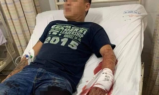 Người đàn ông bị chém gần đứt lìa tay trước cửa nhà