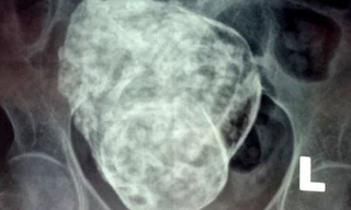 Hình ảnh khối thai đá trong cơ thể bà Sáu