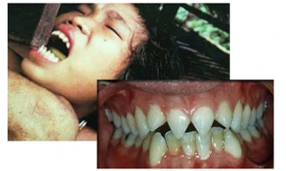 Cận cảnh quá trình mài răng