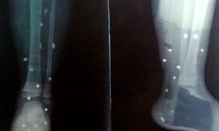 Bé 4 tuổi nhập viện vì trúng loạt đạn hoa cải