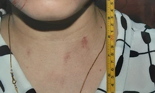 Các vết xước trên cổ nữ nạn nhân được ghi nhận sau khi vùng chạy ra khỏi phòng