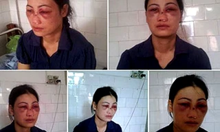 Chị Hoa với đầy thương tích trên khắp cơ thể sau khi bị chồng bạo hành