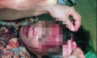 Bà Đào Thị Ph. khi cấp cứu khâu vết thương trên đầu