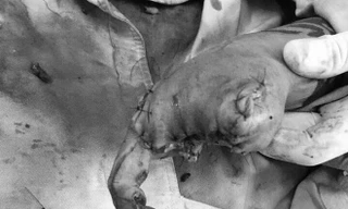 Bàn tay dập nát mất gần hết ngón của chị Uyên