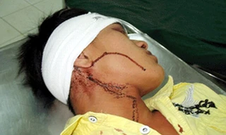 Đứng ra can ngăn nhưng anh Hoàng bị Hùng bắn vào trán gây thương tích - Ảnh có tính chất minh họa