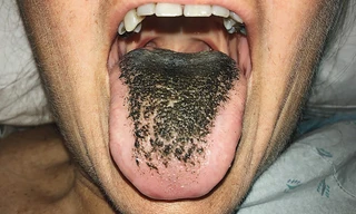 Lưỡi mọc lông có thể là tác dụng phụ của thuốc tây y.