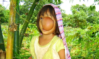 Phẫu thuật thành công ca thoát vị não hiếm gặp