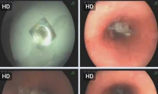 Cấp cứu vì nuốt luôn vỏ thuốc khi uống thuốc