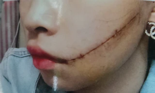 Trên đường đi làm nữ công nhân bị rạch mặt khâu 25 mũi