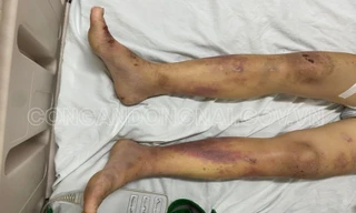  Khởi tố chủ quán cà phê kích dục tra tấn nhân viên đến nhập viện