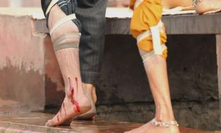 Chữa bệnh bằng trích máu ở Ấn Độ