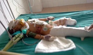 Cháu bé trong vụ nổ xe khó qua cơn nguy kịch