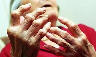 Những bệnh khớp người cao tuổi thường mắc