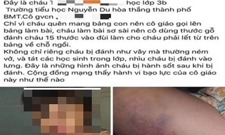 Em Đ bị đánh bầm tím đùi