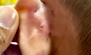 Bạo hành bé trai 4 tuổi thương tích, cô giáo mầm non bị khởi tố