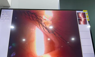 Rận chi chít trên mắt bé gái 5 tuổi