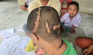 Hơn 70 triệu đồng ủng hộ gia đình bé trai 11 tuổi 7 lần mổ sọ vì TNGT