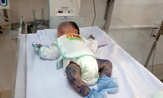 Cứu sống bé trai 13 ngày tuổi bị thủy đậu hiếm gặp 