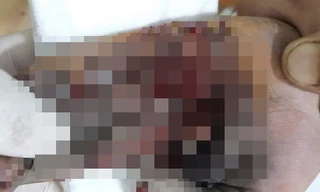 Bàn tay của H. bị dập nát.