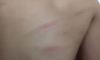 Nhiều vết thương trên lưng em Ng. được gia đình phát hiện