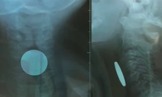 Quảng Bình: Phát hiện đồng xu nằm trong thực quản bé trai 5 tuổi