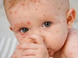 Trẻ sơ sinh bị thủy đậu do bà mẹ mang thai không tiêm vắc xin phòng bệnh