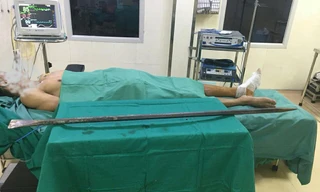 Bệnh nhân và chiếc xà beng đâm xuyên qua chân được các BS Bệnh viện E TƯ phẫu thuật lấy ra khỏi cơ thể.