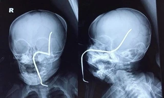 Hình ảnh phim X-quang của cháu H. cho thấy thanh sắt đâm vào gò má trái, xuyên lên vùng não thái dương.