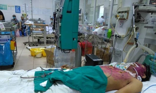 Bệnh nhân Nguyễn T.M đang được điều trị tích cực tại Bệnh viện Bệnh Nhiệt đới Trung ương